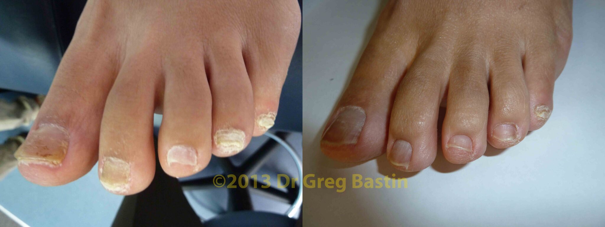 At Home Laser Treatment For Toenail Fungus Laser Treatment for Toenail Fungus