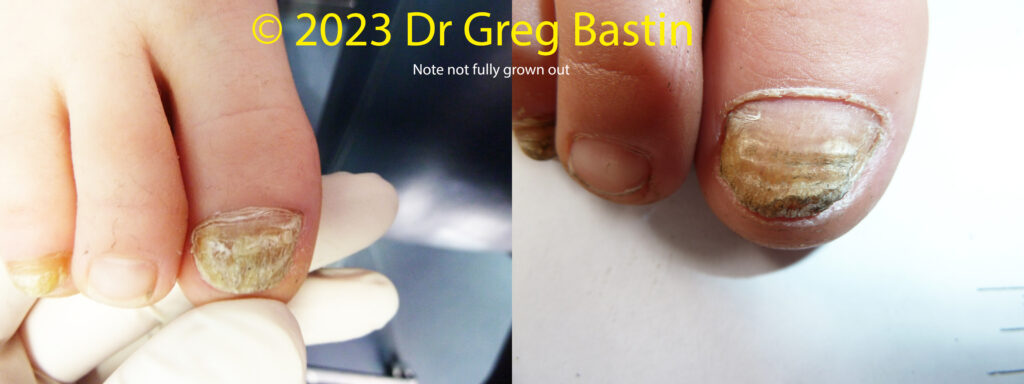 Fungal Nail Specialist in Melbourne