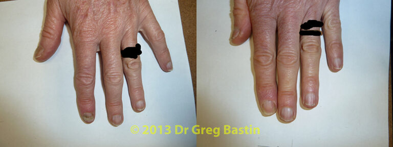 treating-fingernail-fungal-infection