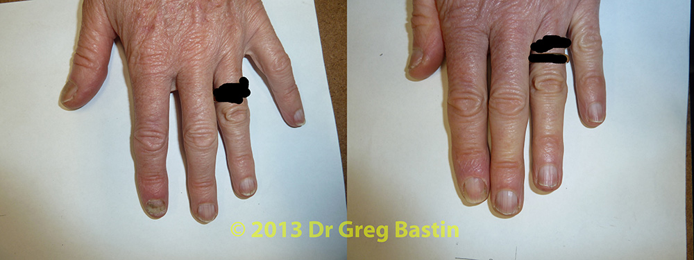 Treating Fingernail Fungal Infection