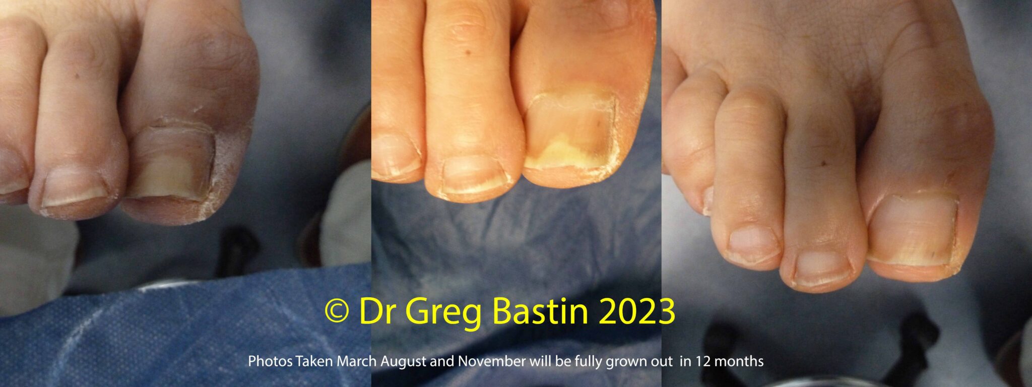 Grow Clear and Healthy Toenails with Lunula Laser Therapy